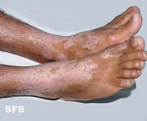 File:Pellagra (Dermatology Atlas 11).jpg