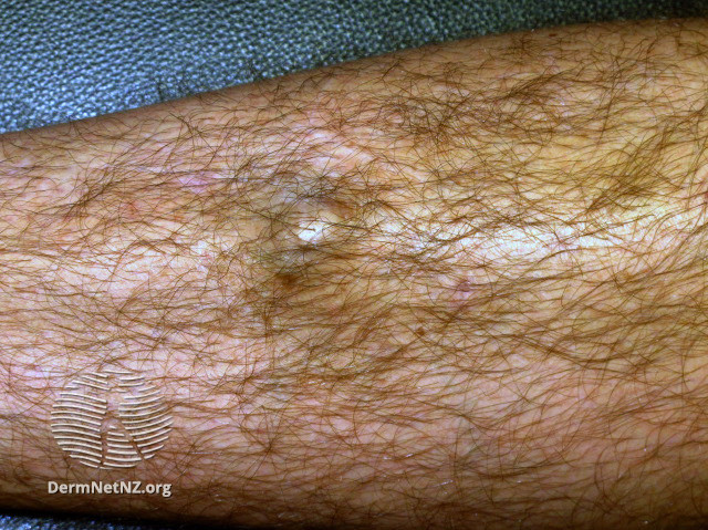 File:Some years after haematoma due to blunt injury (DermNet NZ dermal-infiltrative-osteoma-cutis2).jpg