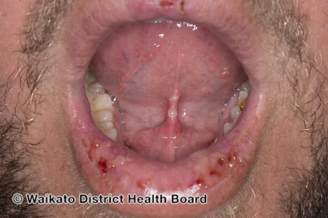 File:(DermNet NZ herpes-simplex-labialis-39).jpg
