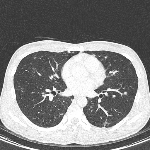 AIDS-related Kaposi sarcoma (Radiopaedia 85247-100811 Axial lung window 95).jpg