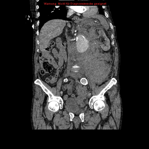 Abdominal aortic aneurysm- extremely large, ruptured (Radiopaedia 19882-19921 Coronal C+ arterial phase 53).jpg
