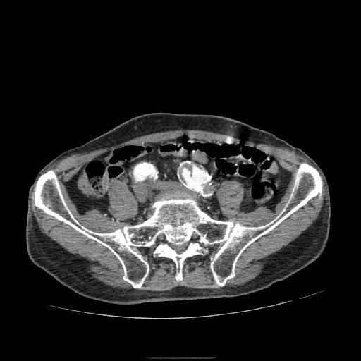 Abdominal aortic aneurysm (Radiopaedia 13341-13340 Axial C+ arterial phase 172).jpg