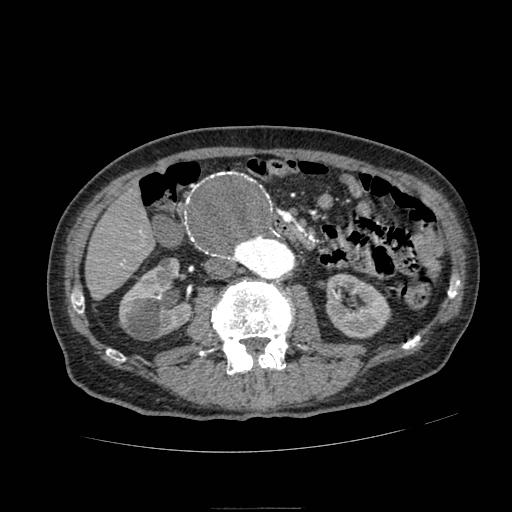 Abdominal aortic aneurysm (Radiopaedia 13341-13340 Axial C+ arterial phase 90).jpg