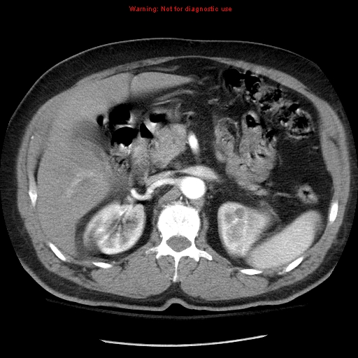File:Abdominal aortic aneurysm (Radiopaedia 8190-9038 Axial C+ arterial phase 28).jpg