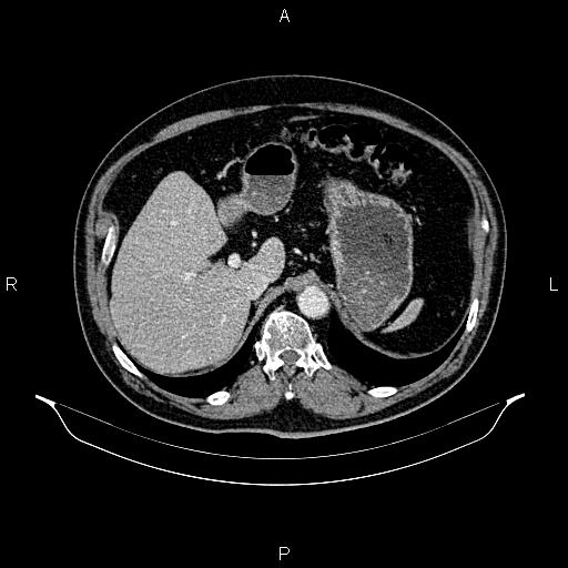 Abdominal aortic aneurysm (Radiopaedia 83094-97462 Axial renal cortical phase 76).jpg