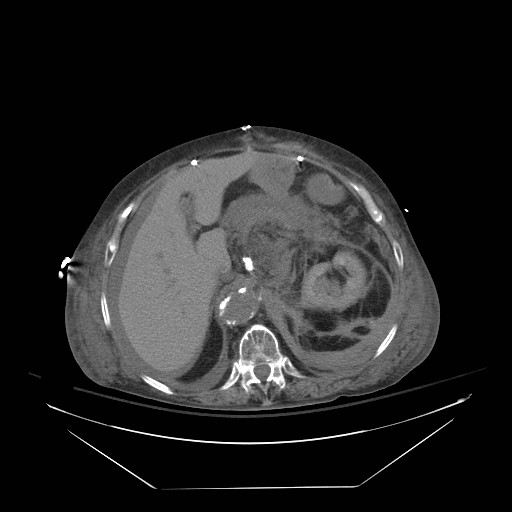 File:Abdominal aortic aneurysm - impending rupture (Radiopaedia 19233-19247 Axial non-contrast 52).jpg