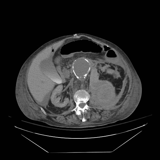Abdominal aortic aneurysm - impending rupture (Radiopaedia 19233-19247 Axial non-contrast 76).jpg