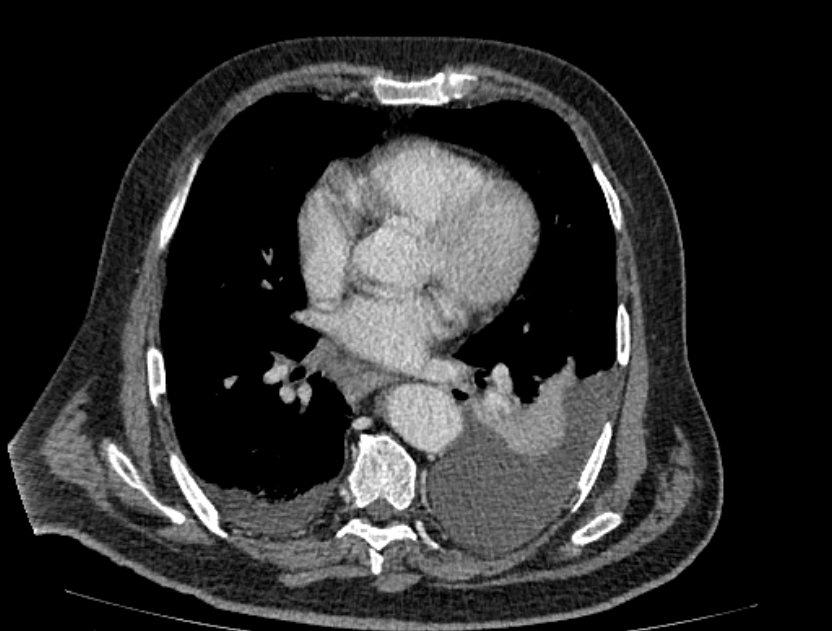 Abdominal aortic aneurysm rupture (Radiopaedia 54179-60362 Axial C+ portal venous phase 41).jpg