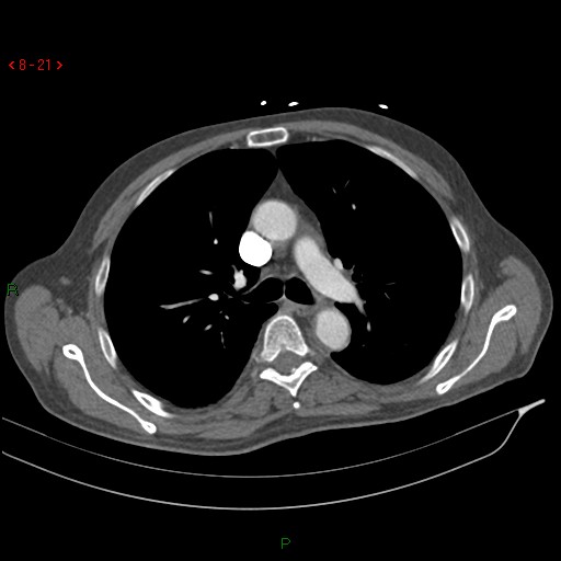 Abdominal aortic aneurysm rupture with aortocaval fistula (Radiopaedia 14897-14841 Axial C+ arterial phase 21).jpg