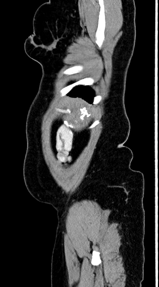 Abdominal hydatid disease (Radiopaedia 68223-77737 Sagittal C+ portal venous phase 3).jpg