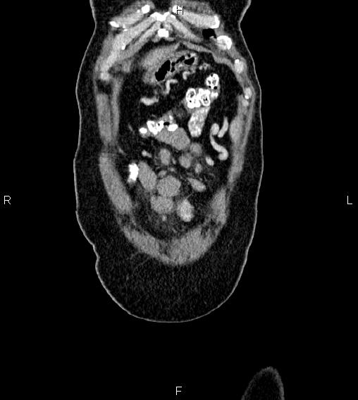 Abdominal lymphoma with sandwich sign (Radiopaedia 84378-99704 Coronal C+ portal venous phase 1).jpg