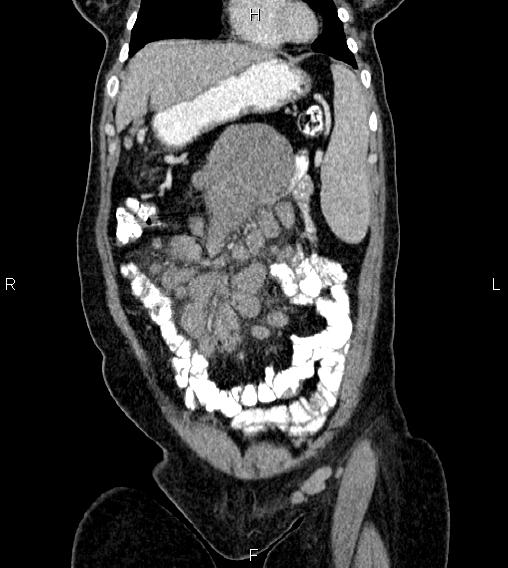 Abdominal lymphoma with sandwich sign (Radiopaedia 84378-99704 Coronal C+ portal venous phase 10).jpg