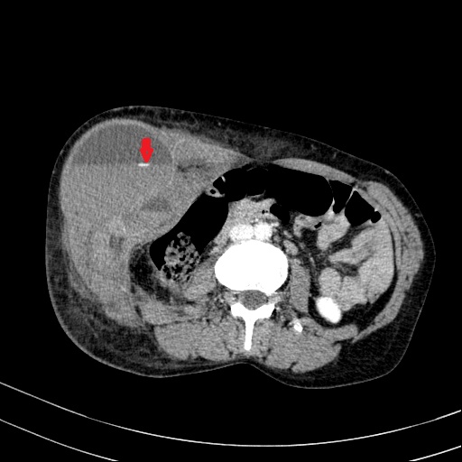 Abdominal wall hematoma with active bleeding (Radiopaedia 83915-99122 Axial contrast-enhanced CT 23).jpg