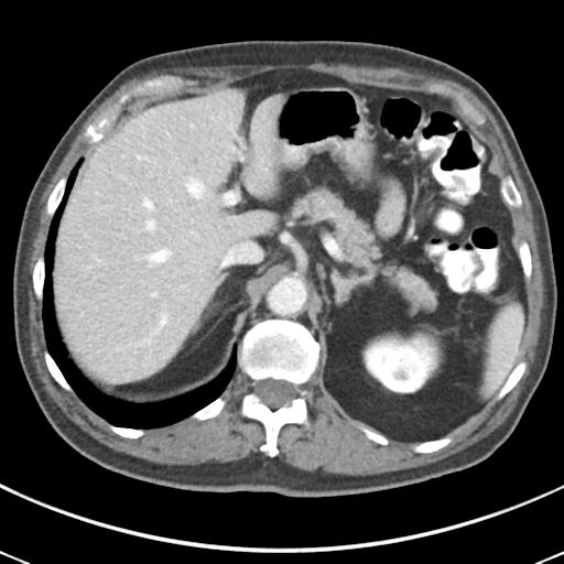 Abdominal wall metastasis from colorectal carcinoma (Radiopaedia 31016-31717 Axial C+ portal venous phase 20).jpg