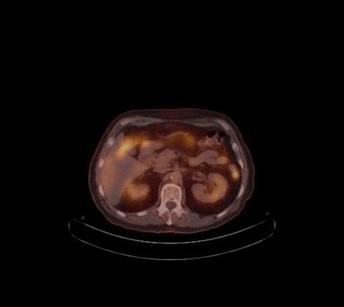 File:Abdominal wall metastasis from colorectal carcinoma (Radiopaedia 31016-31719 C 76).jpg