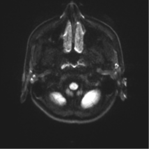 Abducens nerve palsy (Radiopaedia 51069-56648 Axial DWI 28).png