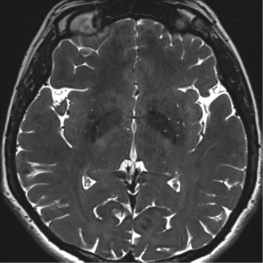 Abducens nerve palsy (Radiopaedia 51069-56648 Axial T2 fat sat 93).png
