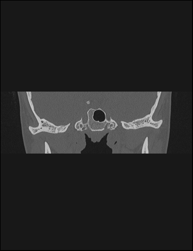 Aberrant right internal carotid artery (Radiopaedia 65191-74198 Coronal non-contrast 12).jpg