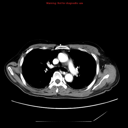 File:Aberrant right subclavian artery (Radiopaedia 9379-10071 Axial C+ arterial phase 26).jpg