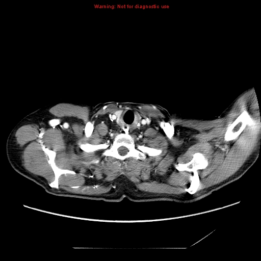 Aberrant right subclavian artery (Radiopaedia 9379-10071 Axial C+ arterial phase 3).jpg