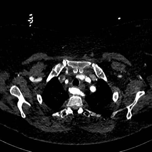 Aberrant right subclavian artery with Kommerell diverticulum (Radiopaedia 47982-52769 Axial C+ arterial phase 17).png