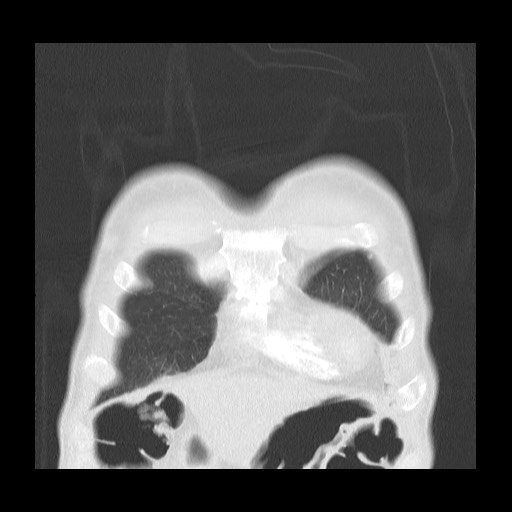 Accessory left horizontal fissure with lingular pneumonia (Radiopaedia 53763-59843 Coronal lung window 7).jpg