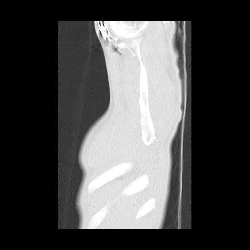 Accessory left horizontal fissure with lingular pneumonia (Radiopaedia 53763-59843 Sagittal lung window 6).jpg