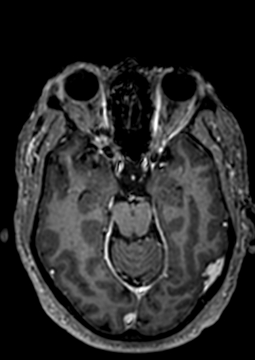 Accessory middle cerebral artery (Radiopaedia 73114-83828 Axial T1 C+ 84).jpg