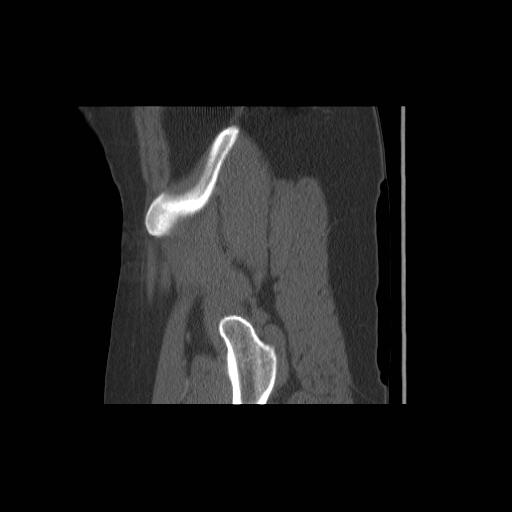 File:Acetabular fracture (Radiopaedia 13193-13212 Sagittal bone window 12).jpg