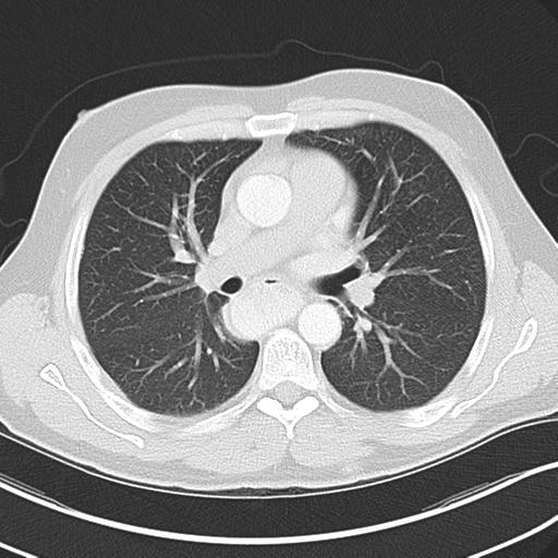 File:Achalasia of the cardia (Radiopaedia 38497-40595 Axial lung window 25).png