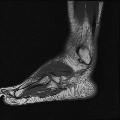 File:Achilles tendon tear (Radiopaedia 77615-89819 Sagittal T1 20).jpg