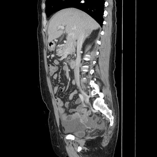 Acinar cell carcinoma of the pancreas (Radiopaedia 75442-86669 Sagittal C+ portal venous phase 83).jpg