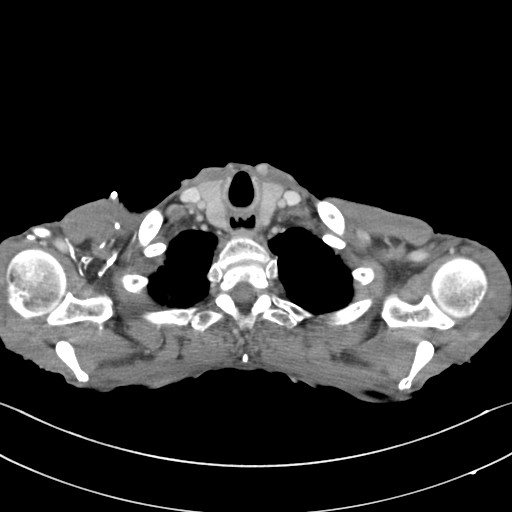 File:Acquired tracheoesophageal fistula (Radiopaedia 57747-65042 Axial C+ portal venous phase 6).jpg