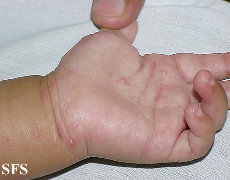 Acropustulosis Infantile (Dermatology Atlas 5).jpg