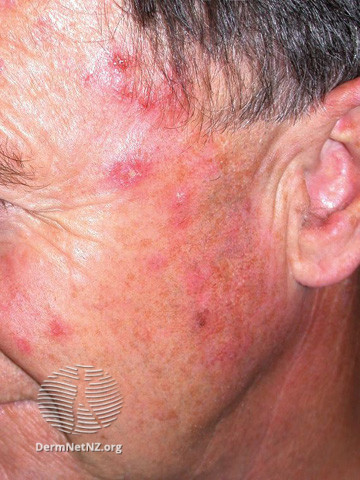 File:Actinic Keratoses treated with imiquimod (DermNet NZ lesions-ak-imiquimod-3749).jpg
