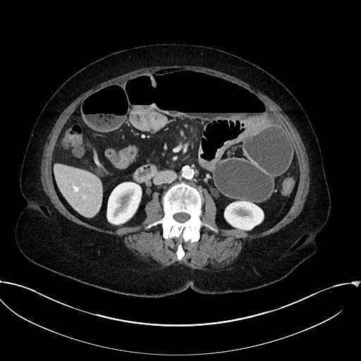 Active Crohn disease (Radiopaedia 59394-66750 Axial C+ portal venous phase 36).jpg