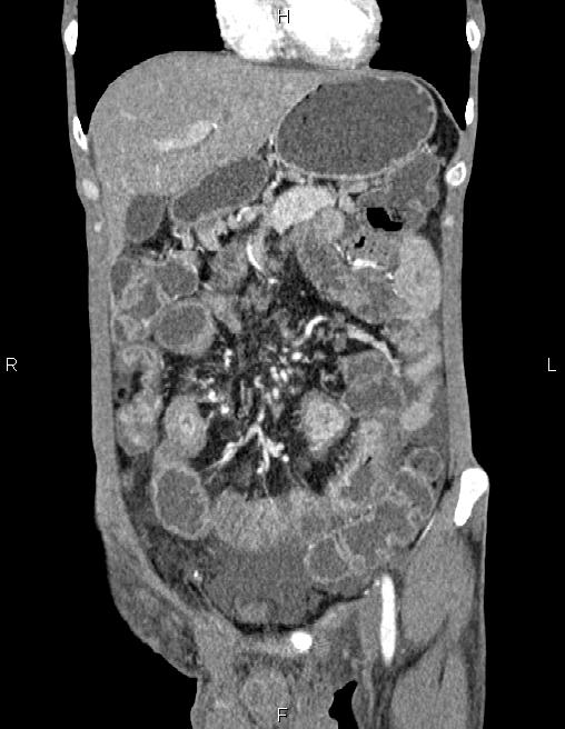 Active crohn disease (Radiopaedia 87133-103397 Coronal C+ arterial phase 18).jpg