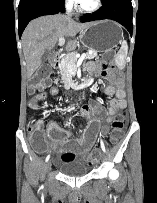 Active crohn disease (Radiopaedia 87133-103397 Coronal C+ arterial phase 25).jpg