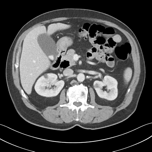 File:Active diverticular hemorrhage (Radiopaedia 39415-41725 Axial C+ portal venous phase 23).png