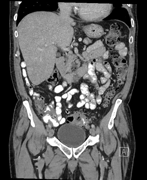 Active lower gastrointestinal bleeding - diverticular (Radiopaedia 61203-69106 Coronal C+ portal venous phase 61).jpg
