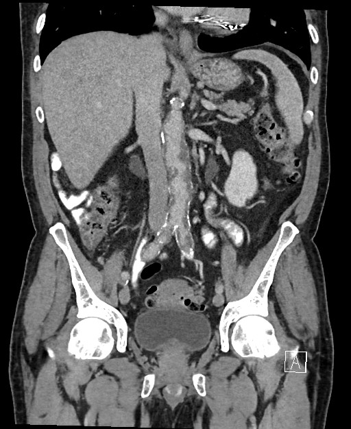 Active lower gastrointestinal bleeding - diverticular (Radiopaedia 61203-69106 Coronal C+ portal venous phase 72).jpg