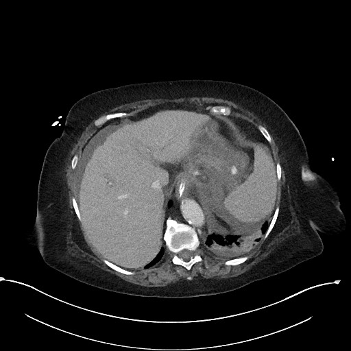 File:Active renal extravasation with large subcapsular and retroperitoneal hemorrhage (Radiopaedia 60975-68796 Axial 323).jpg