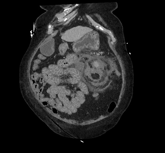Active renal extravasation with large subcapsular and retroperitoneal hemorrhage (Radiopaedia 60975-68796 Coronal C+ portal venous phase 40).jpg