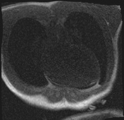 File:Active right ventricular cardiac sarcoidosis (Radiopaedia 55596-62100 Axial Dynamic perfusion scan MOCO 19).jpg