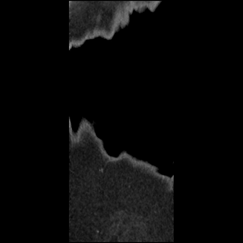 Acute Schmorl's node (Radiopaedia 83276-102365 Coronal non-contrast 51).jpg