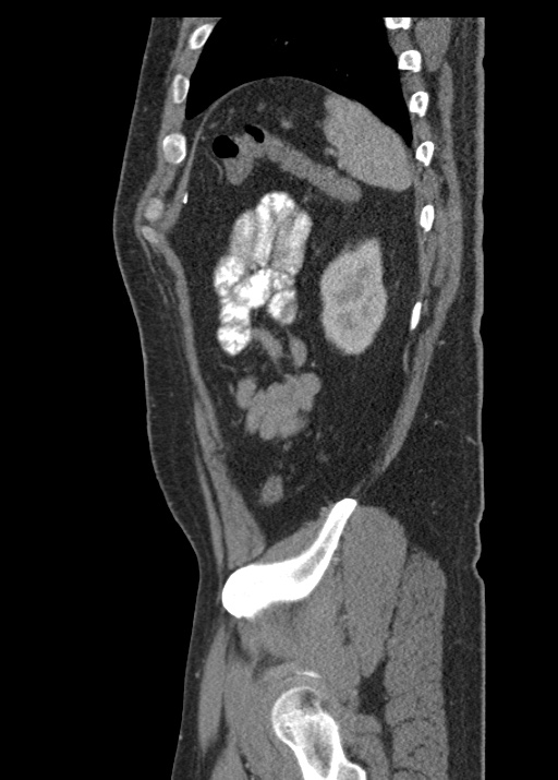 Acute appendicitis (Radiopaedia 48511-53463 Sagittal C+ portal venous phase 107).jpg