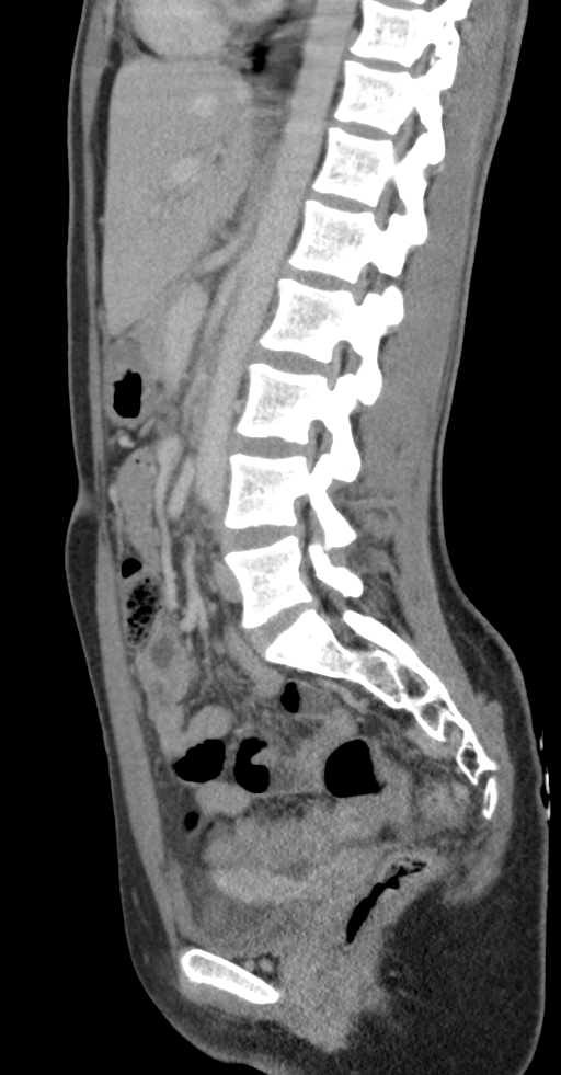 Acute appendicitis (Radiopaedia 62608-70901 Sagittal C+ portal venous phase 15).jpg