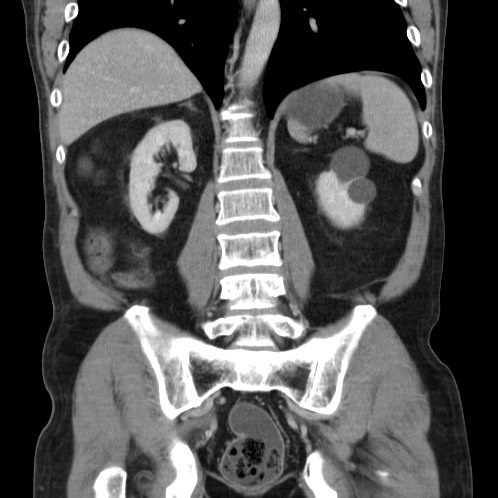 Acute appendicitis (Radiopaedia 66513-75790 Coronal C+ portal venous phase 60).jpg