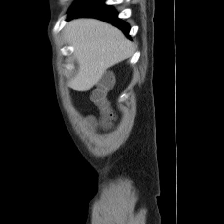 Acute appendicitis (Radiopaedia 66513-75790 Sagittal C+ portal venous phase 7).jpg
