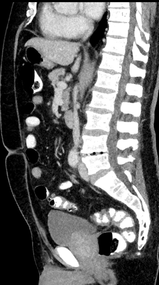 Acute appendicitis (Radiopaedia 77016-88960 Sagittal C+ portal venous phase 58).jpg